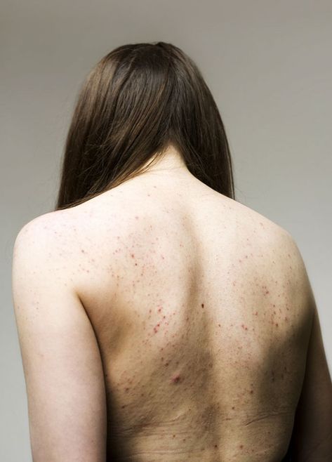 Women-Skin-Problems-Epidermis-Project-Sophie-Harris-Taylor Photographie Art Corps, Body Positive Photography, Skin Details, Streetwear Apparel, Normal Body, Real Bodies, Body Photography, Women Skin, Ootd Photography