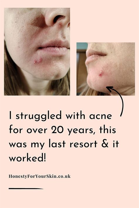 When we started Kristine rated her acne as a 6/10 and was having monthly hormonal breakouts – now she’s consistently clear! #acnetreatment #acnehelp #honestyforyourskin Skincare Hormonal Acne, Hormonal Acne Tips, Clear Hormonal Acne, Acne Journey, Clear Skin Remedies, Cystic Acne Remedies, Clear Skin Naturally, Hormonal Breakouts, Acne Help