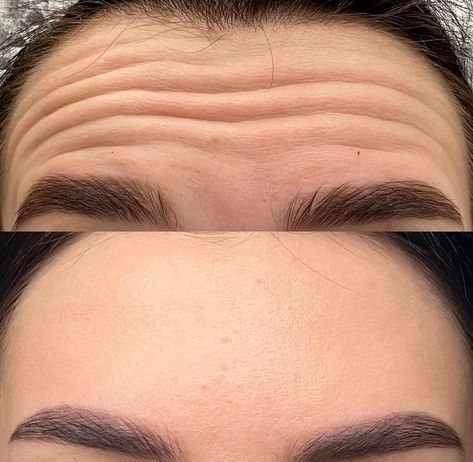 Botox works wonders 😍🔥 What a beautiful result 😍 Tired of having wrinkles and fine lines? No worries 😉  Just DM me or call for a Botox appointment ❤️ It won’t bother you anymore 💯 📲 (917) 701-0253  📞 (585)441-3838 #botoxnewyork #botoxinjections #botoxinjectionsnyc #botoxfacial #botoxtreatment #botoxtreatmentnyc #botox Botox Results, Vitamin C Skincare, Botox Injection, Bright Glowing Skin, Botox Before And After, Face Scars, Natural Toner, Natural Vitamin C, Wrinkle Serum