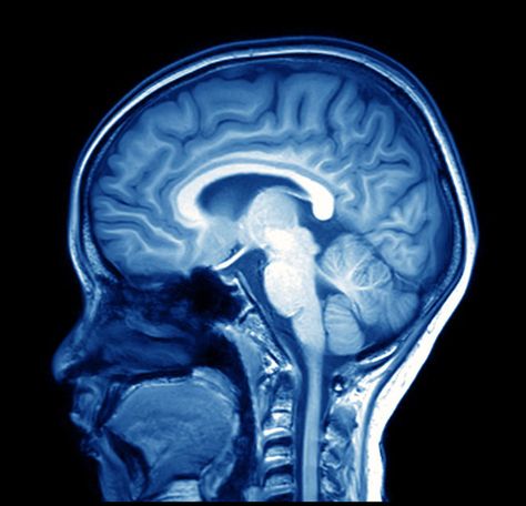 The Amount of Gray Matter in Your Brain May Predict If You'll Stick to Your Diet Mri Brain, Types Of Strokes, Brain Images, Frontal Lobe, Mri Scan, Brain Scan, Magnetic Resonance Imaging, Ct Scan, Magnetic Resonance