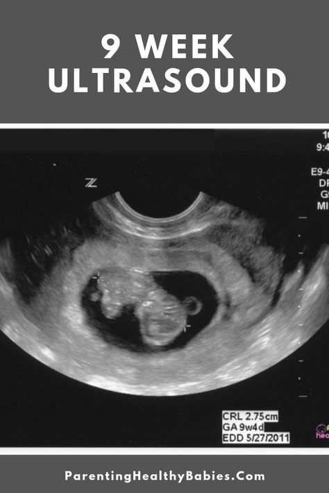 9 Week Ultrasound Picture, 10 Weeks Pregnant Ultrasound, 9 Weeks Pregnant Ultrasound, 9 Week Ultrasound, Ultrasound Gender, 9 Weeks Pregnant, 10 Weeks Pregnant, Medical Sonography, Diagnostic Medical Sonography