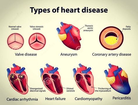 There are many types of heart disease that affect different parts of the organ and occur in different ways. Congenital heart disease. ...… Types Of Heart, Cardiac Disease, Heart Diseases, Cardiac Nursing, Congenital Heart, Medical School Studying, Coronary Arteries, Heart Conditions, Medical Anatomy