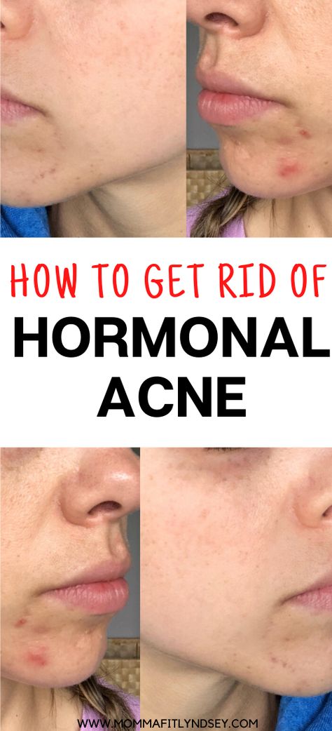 How to Get Rid of Hormonal Acne or Cystic Acne Naturally.  Get rid of chin acne with gut healing foods and natural products Home Remedy For Face Acne, How To Get Rid Of Hormonal Acne Fast, How To Get Rid Of Redness On Face From Acne, Acne Chin And Jaw, Cystic Hormonal Acne, Heal Acne Fast, How To Get Rid Of Chin Acne Overnight, Jaw Acne Causes, How To Keep Your Face Acne Free