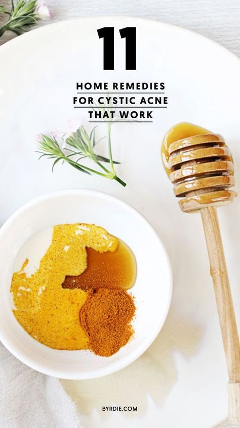 Get Rid Of Cystic Acne, Treating Cystic Acne, Cystic Acne Remedies, Chest Acne, Natural Acne, Natural Acne Remedies, Home Remedies For Acne, Hormonal Acne, Cystic Acne