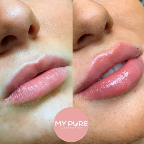 @lipfillerscollective posted to Instagram: 📍 West & South West London ✖ My Pure Aesthetics 👩🏼‍⚕️ Nurse ⁣📷 @mypureaesthetics ⁣⁣⁣⁣⁣⁣#lips #dermalfiller #filler #lipfillers #pout #Kiss #cosmeticinjectables #cosmetic #lipinjections #cosmeticdoctor #perfectlips #lipsonpoint #lipenhancement #lipsoftheday #biglips #lipstick #redlips #cosmeticnurse #cosmeticdoctor #lipsonfleek #lipsonpoint #kyliejennerlips #kylielips #lipliner #biglips #lipinjections #lip Fil Different Lip Filler Shapes, Aesthetics Nurse, Dermal Fillers Lips, Pure Aesthetic, Lips Inspiration, Botox Lips, Kylie Jenner Lips, Facial Fillers, Cosmetic Injectables