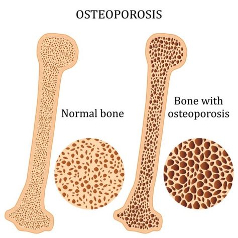 Normal Bone and Bone with Osteoporosis Comparison Osteoporosis Symptoms, Eye Twitching, Nutrition Club, Bone Strength, Bone Loss, Bone Density, Healthy Bones, Vitamin K, Bone Health