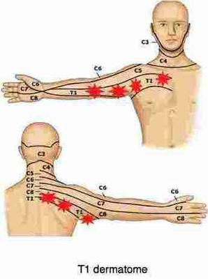 Tingling right hand, ache in arm, pain in arm pit and front right of chest, and pain in back by shoulder blade and side of neck.  All on the right.  Several Trigger Points, Tingling In Fingers, Pain In Back, Punkty Spustowe, Severe Back Pain, Spine Health, Upper Back Pain, Muscle Anatomy, Medical Anatomy