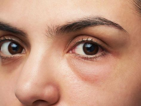 These Are The Reasons You Have Puffy Under Eyes by Marli Oxenholm - Musely Puffy Bags Under Eyes, Puffy Eyes Remedy, Bags Under Eyes, Swollen Eyes, Fluid Retention, Under Eyes, Dark Circles Under Eyes, Under Eye Bags, Eye Drops