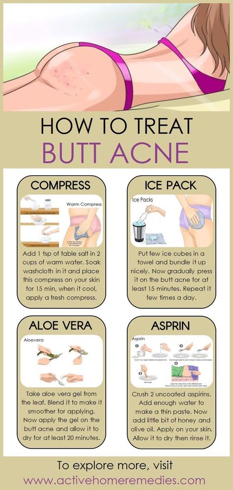 How to Treat Butt Acne Naturally - Fitness / Inspiration - #Akne #Treating ...  #fitness #inspiration #naturally #treat #treating Check more at http://3m.mrpublicdr.xyz/2019/09/03/how-to-treat-butt-acne-naturally-fitness-inspiration-akne-treating/ Corp Perfect, Forehead Acne, Natural Acne, Natural Acne Remedies, Home Remedies For Acne, Cystic Acne, Acne Remedies, How To Get Rid Of Acne, Acne Skin