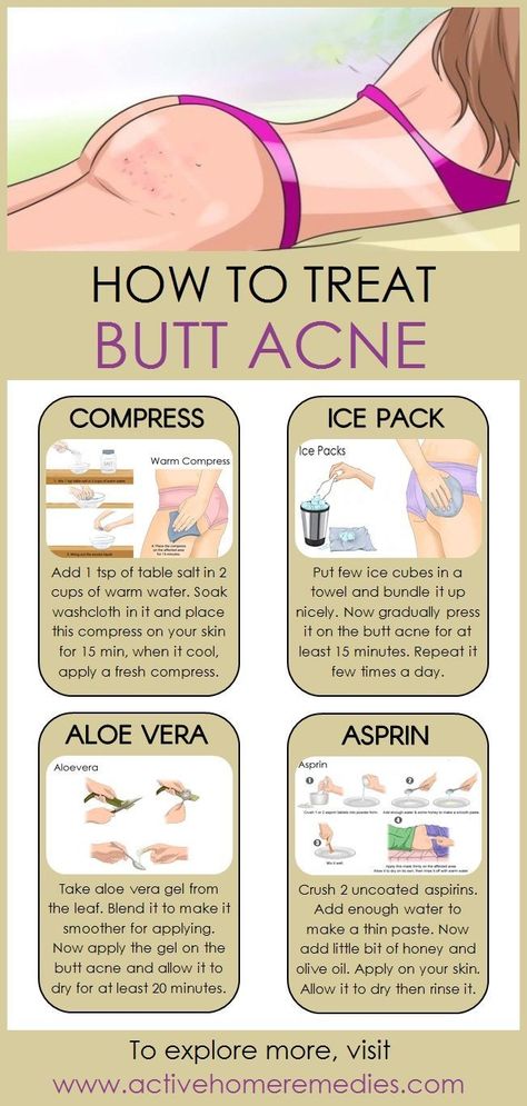 How to Treat Butt Acne Naturally - Fitness / Inspiration - #Akne #Treating ...  #fitness #inspiration #naturally #treat #treating Check more at http://3m.mrpublicdr.xyz/2019/09/03/how-to-treat-butt-acne-naturally-fitness-inspiration-akne-treating/ Homemade Skin Care, Forehead Acne, Natural Acne, Home Remedies For Acne, Cystic Acne, Acne Remedies, Acne Skin, How To Treat Acne, Skin Care Regimen