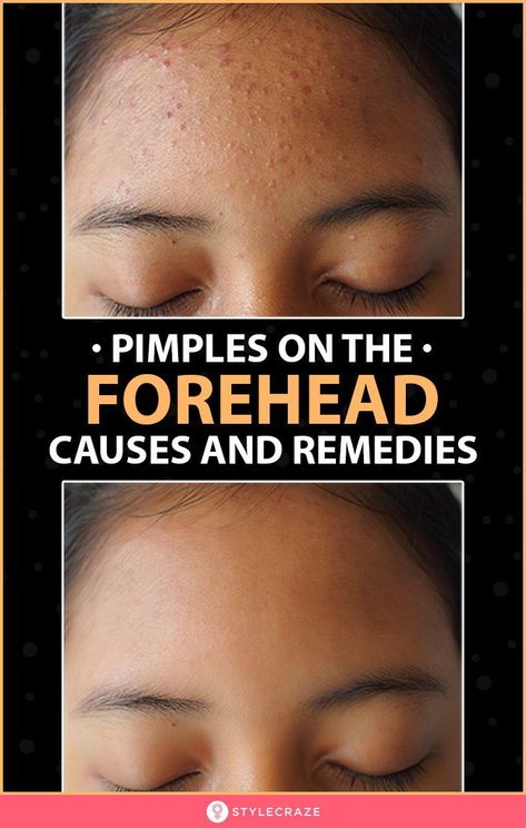 Acne is characterized by the appearance of small, red, and inflamed bumps on your skin and forehead. This happens as a result of clogged pores as you are likely to be exposed to pollution, dust, and other impurities. #Acne #Pimples #ForeheadAcne #Skincare #Remedies #Beauty #BeautyTips Small Pimples On Face, Forehead Acne Cause, Get Rid Of Forehead Acne, Small Bumps On Face, Forehead Bumps, Pimples On Forehead, Face Mapping Acne, Prevent Pimples, Forehead Acne