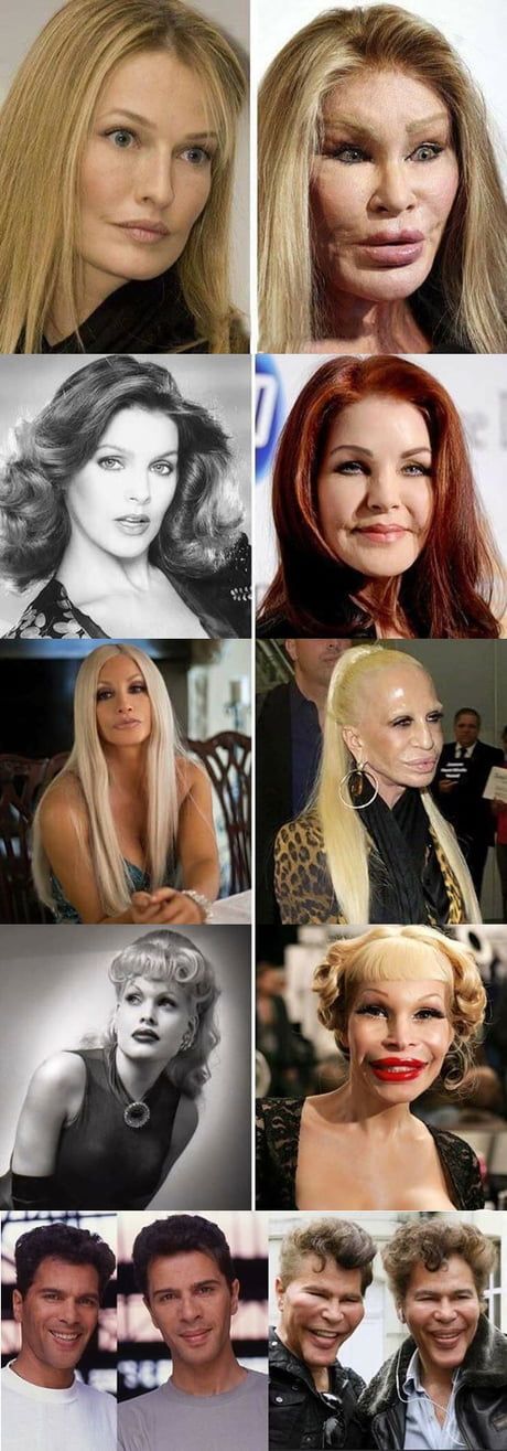 Wonders of modern plastic surgery Plastic Surgery Facts, Plastic Surgery Fail, Bad Plastic Surgeries, Plastic Surgery Gone Wrong, Celebrity Plastic Surgery, Back Porch Ideas, Summer Dresses For Wedding Guest, Homecoming Dresses Black, Gone Wrong