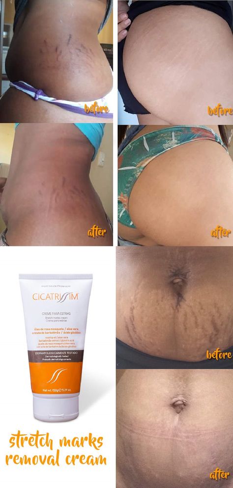 Stretch Mark Removal Cream, Strech Marks, Marks Cream, Lotion For Oily Skin, Tips For Oily Skin, Stretch Mark Cream, Stretch Mark Removal, Skin Care Wrinkles, Moisturizer For Oily Skin