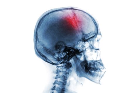 New research in Oxford could lead to improvements in recovery of stroke survivors Oral Maxillofacial, Brain Stimulation, Improve Cognitive Function, Periodontal Disease, Dental Procedures, Brain Damage, Dental Care, Disease, Brain