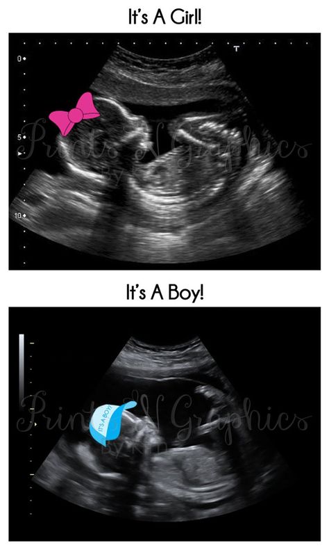 Pin for Later: 30 Creative Gender-Reveal Ideas That You'll Want to Consider ASAP A Customized Sonogram Vom Avea Un Copil, Simple Gender Reveal, Twins Pregnancy, Creative Gender Reveals, Postpartum Care Kit, Gender Reveal Announcement, Pregnancy Gender, Gender Reveal Photos, Pregnancy Gender Reveal