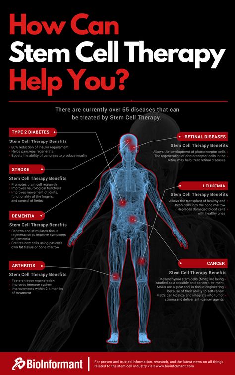 How Can Stem Cell Therapy Help You? | What Diseases Can Be Treated with Stem Cell Therapy | Research continues to find ways to utilize stem cells to improve the quality of life of patients. Currently, regenerative medicine has a list of common diseases which stem cell therapy can greatly benefit. Stem Cells Notes, Stem Cells Therapy, X39 Patch, Common Diseases, Stem Cell Research, Stem Cell Therapy, Cell Therapy, Cell Regeneration, Regenerative Medicine