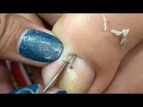 HOW TO CUT THICK TOENAILS - Toenail Cleansing Satisfying #285 Ingrown Nail Removal, Curved Toenails, Clean Toenails, Cleaning Satisfying, Toenail Removal, Infected Toenail, Long Toenails, Cleaning Videos, Ingrown Nail