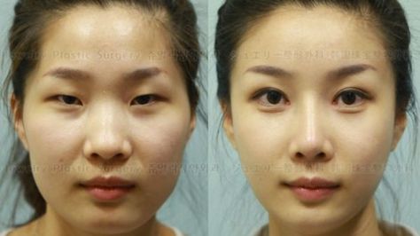 South Korean Plastic Surgeons Are Too Good At Their Job South Korean Plastic Surgery, Korean Plastic Surgery, Beauty Diy Skincare, Bigger Eyes, Beauty Hacks Skincare, Passport Photo, Reconstructive Surgery, Eye Surgery, Skin Care Routine Steps