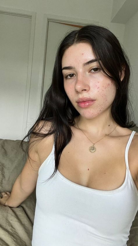 Pretty Ppl With Acne, Bad Acne Pictures, Beautiful People With Acne, Acne Girls Pretty, Girls With Acne Pretty, Pretty People Without Makeup Natural Beauty Faces, Pretty People Natural Beauty, Models With Acne, Acne Confidence