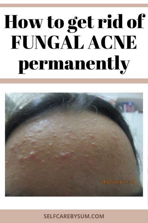 Methods to do away with small bumps on brow - Self-Care by Sum Fungle Acne, Tiny Bumps On Forehead, Forhead Acne, Get Rid Of Fungal Acne, Bumps On Forehead, Small Bumps On Forehead, Nizoral Shampoo, Small Bumps On Face, Forehead Bumps