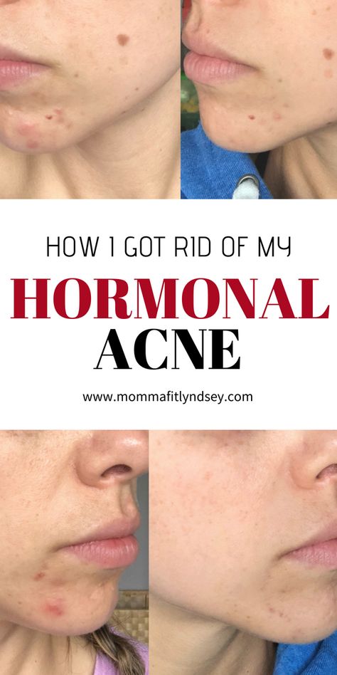 Treat Hormonal Acne with Gut Healing Foods - Momma Fit Lyndsey