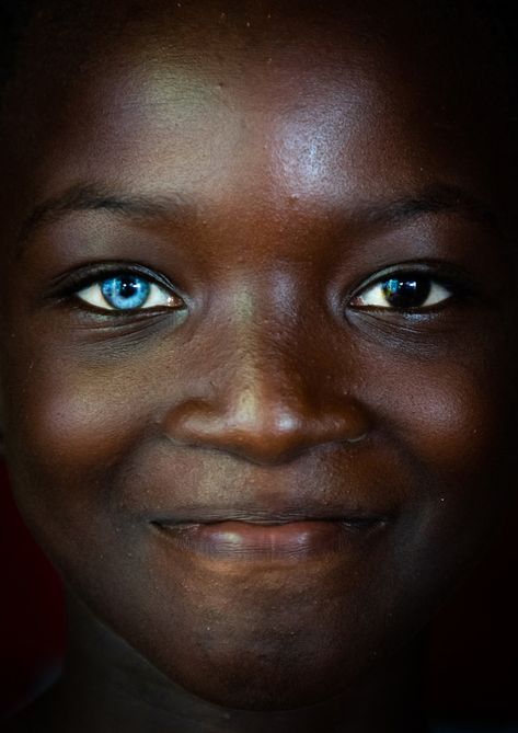 https://flic.kr/p/25nXam6 | Beautiful african girl with heterochromia iridis causing two different colored eyes, Moyen-Comoé, Abengourou, Ivory Coast | © Eric Lafforgue www.ericlafforgue.com People With Two Different Colored Eyes, Two Different Eye Colors People, Girl With Heterochromia, African Eyes, Dark Skin Blue Eyes, Lunar Dragon, Heterochromia Eyes, Two Different Colored Eyes, Rare Eye Colors