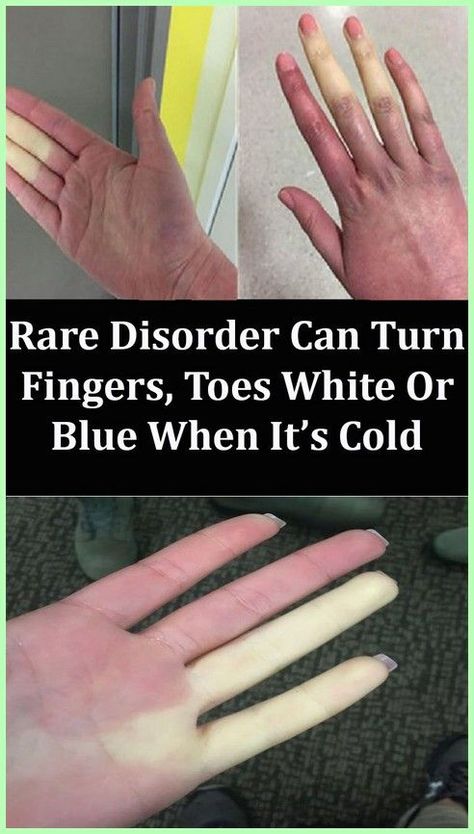 Rare Disorder Can Turn Fingers, Toes White Or Blue When It�s Cold Home Remedies, Rare Disorders, Home Medicine, Finger Tips, Natural Juices, Some Body, Coping Mechanisms, Weights Workout, Fitness Beauty