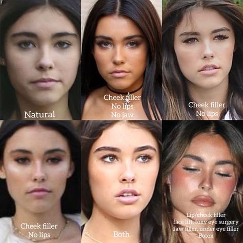 Filler Nose Job, Brows And Lips Makeup, Filler Nose Job Before After, Madison Beer Plastic Surgeries, Jaw And Chin Filler, Corner Lip Lift, Hip Filler Before And After, Eyebrow Botox Lift, How To Lift Your Eyes