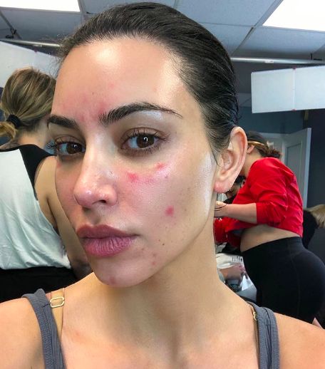 Normalize Acne, Pretty People With Acne, Makeup With Acne, Kim Kardashian Selfie, Acne Positivity, Girl With Acne, Kim Kardashian Snapchat, Estilo Kardashian, Bad Acne