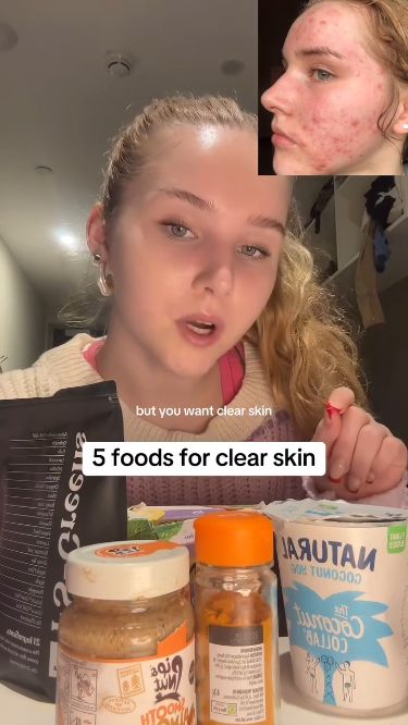 clear skin foods 🫚🥦 Skincare Steps For Acne Prone Skin, Herbs For Acne Clear Skin, How To Get Healthy Skin, Natural Beauty Hacks Skincare, Acne Makeup Routine, Skin Care Solutions Natural, Acne Scar Skin Care Routine, Makeup Acne Skin, Sulfur For Acne