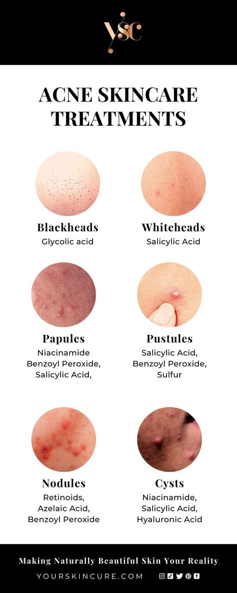 Healthy Skin Care Acne, Different Types Of Acne, Haut Routine, Acne Skin Care, Skin Facts, Flot Makeup, Skin Advice, Skin Care Routine Order, Skin Care Guide