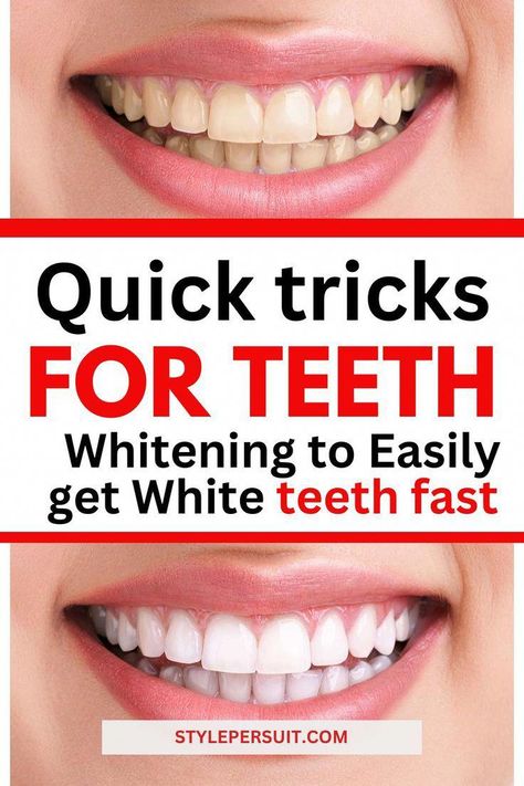 A bright, radiant smile is often considered a person's best accessory. It exudes confidence, warmth, and health. Say goodbye to teeth stains and yellow teeth. Learn how to whiten teeth with the best teeth whiting remedies that work really overnight Try Natural Teeth Whiting at Home Remedies today #BestOralCareAdvice Tooth Pain Relief, Teeth Whiting At Home, Baking Soda Teeth Whitening, Get Whiter Teeth, Teeth Whitening Diy, Grills Teeth, Dental Cavities, Yellow Teeth, Nice Teeth