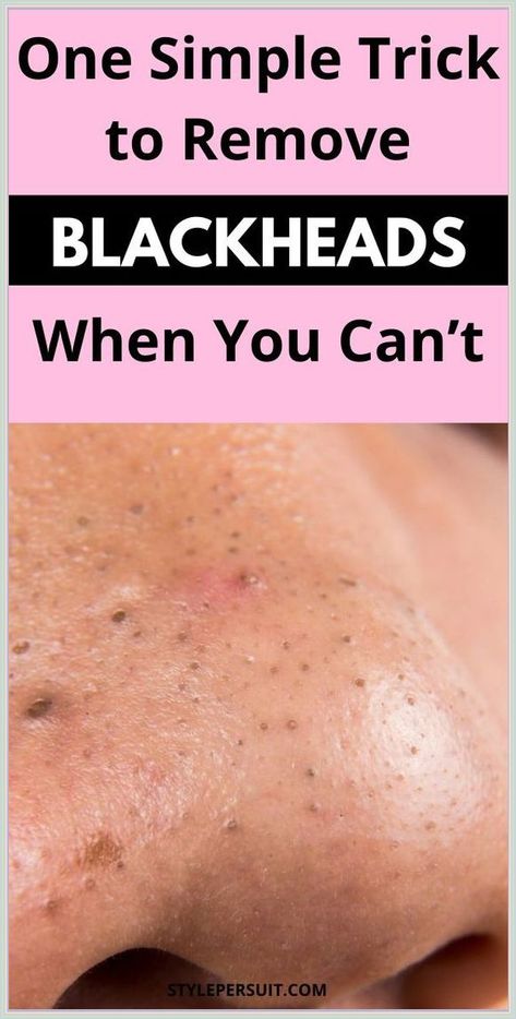 Get Rid of Blackheads For Good Blackheads Removal Cream, Blackheads On Face, Remove Blackheads From Nose, Blackhead Remover Diy, Blackhead Remedies, Black Heads, Blackheads On Nose, Blackheads Removal, Rid Of Blackheads