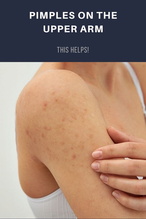 Arm Pimples, Body Pimples, Arm Acne, Back Pimples, Redness Pimple, Getting Rid Of Scars, Blind Pimple, Prevent Pimples, Pimples Under The Skin