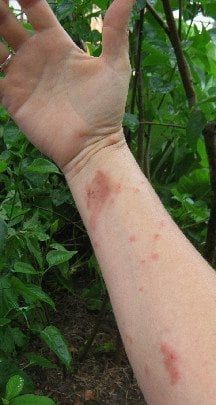 Poison Oak/Poison Ivy Rash: Contact Dermatitis | The Practical Herbalist Essential Oils For Poison Oak, Poison Sumac Remedies, Poison Oak Rash Pictures, Poison Oak Remedy, Poison Ivy Rash Pictures, Poison Sumac Rash, Poison Oak Rash, Poision Ivy, Diy Makeup Remover Wipes