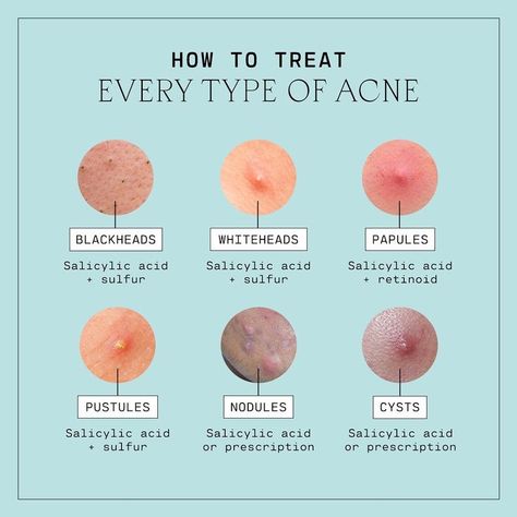 From blackheads to cysts, breakouts happen to pretty much everyone.🗣️ Say it with us: Acne is normal! Here's a handy guide on how to treat every type of acne. Save this for later and click to read The Good Skin Blog for a detailed breakout down. Type Of Acne, Skin Facts, Skin Advice, Natural Face Skin Care, Natural Acne Remedies, Types Of Acne, Basic Skin Care Routine, Skin Care Tutorial, Acne Scar Removal