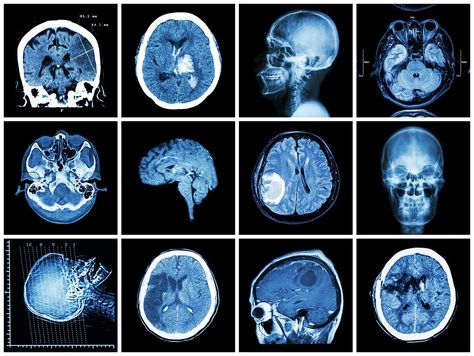 Abnormality Brain Scan Brain Imaging, Scientific Art, Mri Brain, Basal Ganglia, Hyperbaric Oxygen Therapy, Brain Surgeon, Brain Images, Pet Scan, Brain Diseases