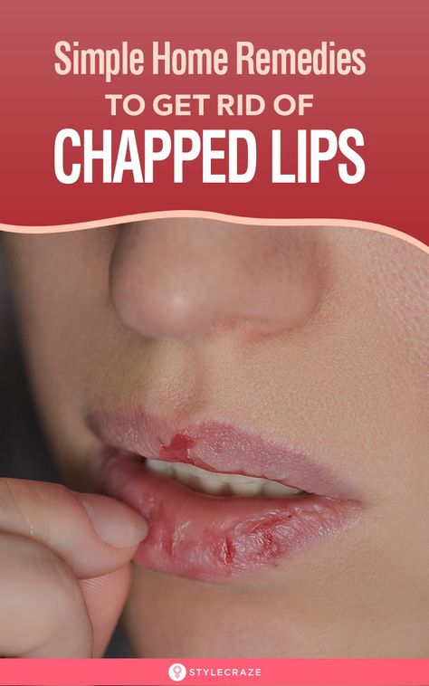 10 Simple Home Remedies To Get Rid Of Chapped Lips: Water is an essential part of any beauty regimen. It helps to keep your body and skin well hydrated. No matter how many remedies or lip balms you use, if you do not drink enough water, your chapped lips are going to keep coming back. So, first and foremost, drink plenty of water during the day and use the remedies given in this article for faster results. #Beauty #BeautyTips #ChappedLips #LipCare #Remedies #HomeRemedies #NaturalRemedies Sunburnt Lips, Sunburned Lips, Chapped Lips Remedy, Lip Healing, Dry Cracked Lips, Drink Enough Water, Natural Remedies For Migraines, Dry Skin Remedies, Cracked Lips