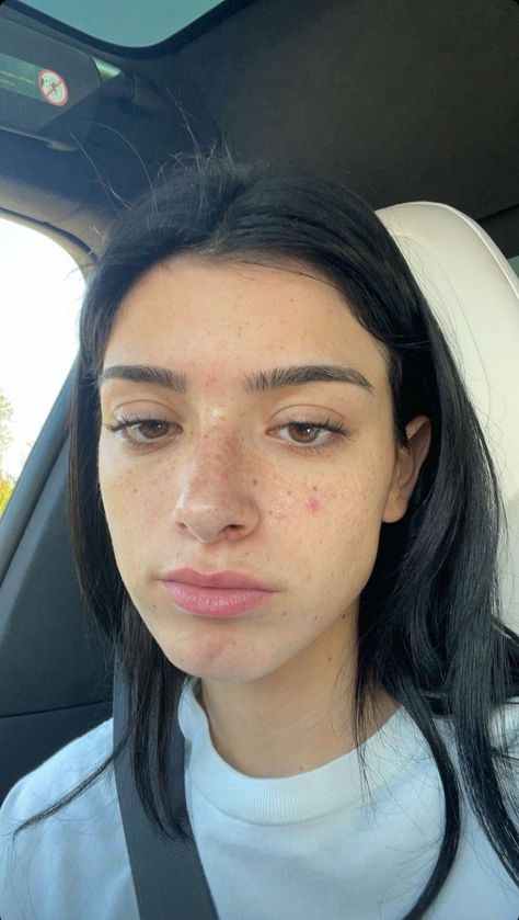 Acne Girls Pretty, Forhead Acne, Pretty People With Acne, Closed Comedones, Girl With Acne, Skin Blackheads, Head Acne, Skin Positivity, Acne Beauty