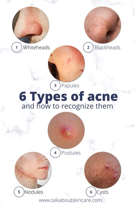 Different Acne Types, Type Of Acne And How To Treat, Types Of Acne On Face, What Your Acne Is Telling You, Types Of Acne And How To Treat, Acne Types, Type Of Acne, Treat Acne Naturally, Different Types Of Acne