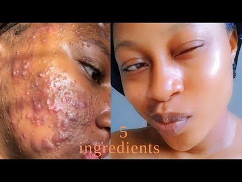 How to Remove Stubborn pimples|Dark spots|Acne|Fast!!! 5 ingredients| Get a Glass skin#clear#acne Face Pimples Remedies, How To Treat Pimples, Clear Acne Fast, Pimple Free Skin, Clear Skin Routine, How To Clear Pimples, Home Remedies For Pimples, Pimples Under The Skin, Pimples On Face