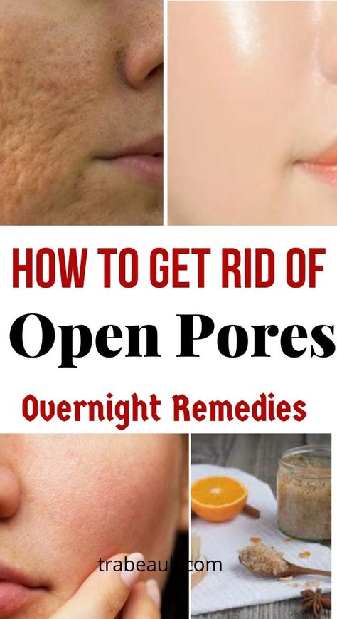How To Close Pores, Open Pores On Face, Get Rid Of Pores, Dry Oily Skin, Acne Prone Skin Care, Lotion For Oily Skin, Face Pores, Open Pores, Eye Skin Care