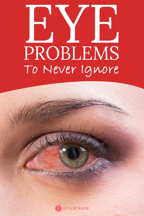 teary Dry Eye Remedies, Eye Floaters, Eye Problems, Eye Exercises, Clear Eyes, Eyes Problems, Saggy Skin, Natural Cold Remedies, Lose 40 Pounds