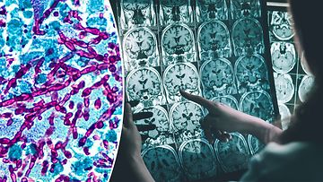 Alzheimerin tautidin taustalla sammassieni?