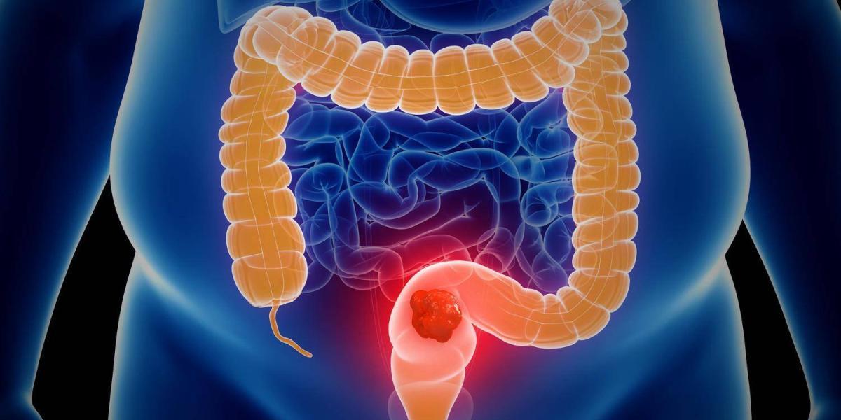 Con una colonoscopia se puede ver si hay pólipos en el colon, cáncer de colon o lesiones vasculares.