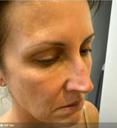 Nat shared the ‘pimple’ on her nose, which turned out to be skin cancer. 