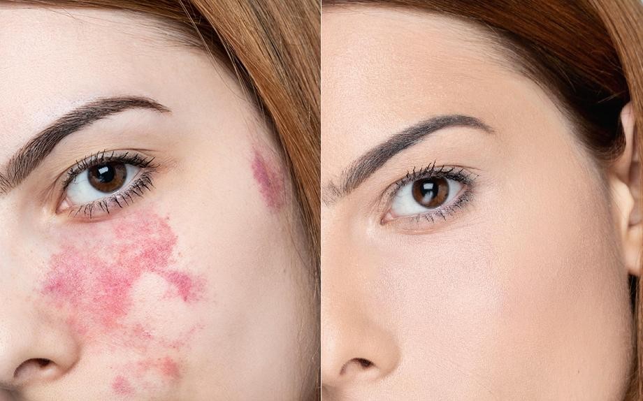 Angioma: quando e come è possibile intervenire con il make-up