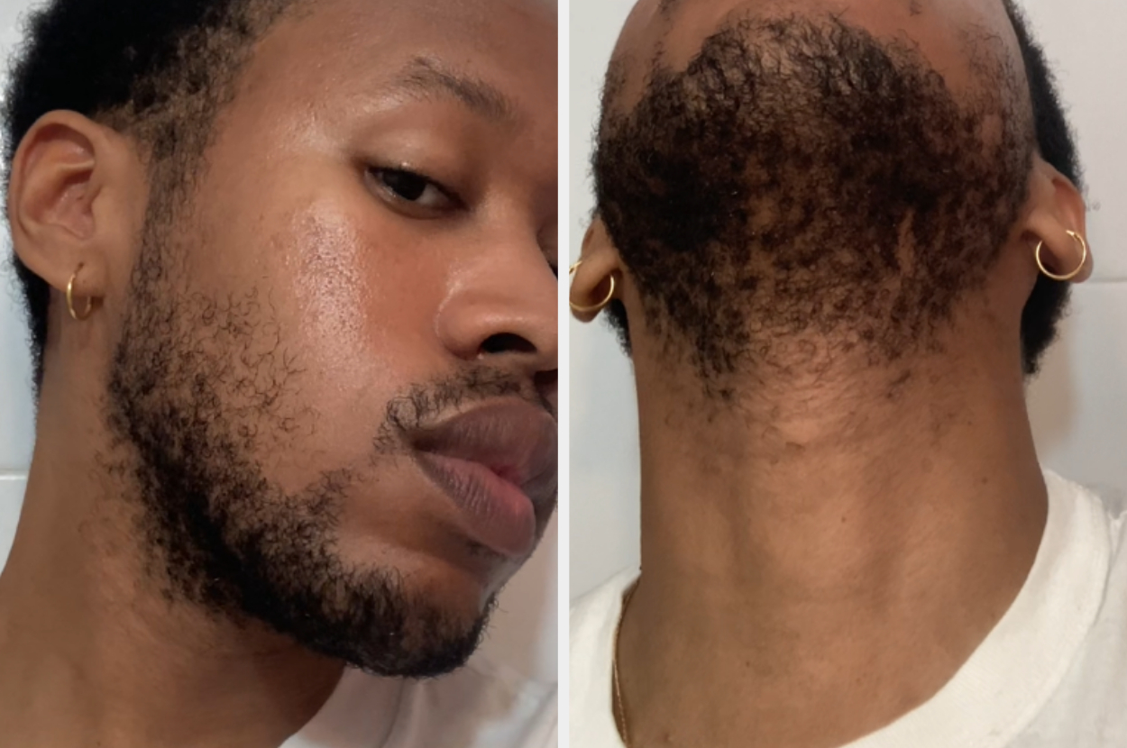 Close-up images of a person&#x27;s face, showcasing patchy beard growth on the side and under the chin. The person has short hair and is wearing gold hoop earrings