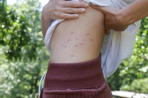 Close-up of a person's torso with multiple red insect bites on the side. The person is lifting their shirt to reveal the bites. Trees are visible in the background