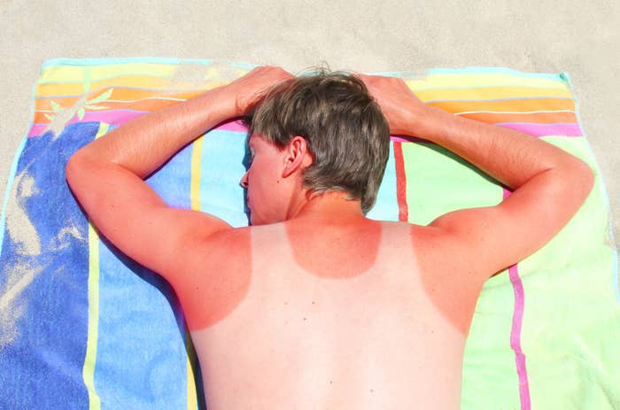 A person is lying face down on a beach towel with a visible sunburn on their back and arms